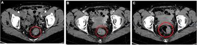 Polypoid arteriovenous malformation of the rectum: A case report